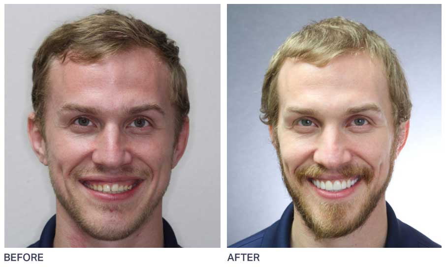 Before and after smile makeover