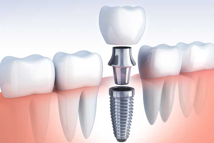 Implant tooth