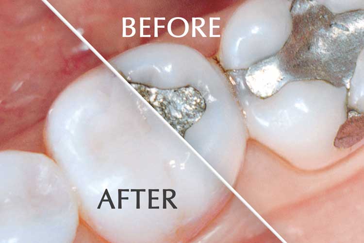Before and after fillings