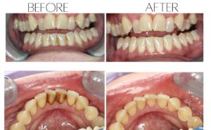 Debribement of a patient who's never been to the dentist at 43yrs