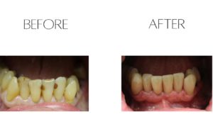 Lower anterior crowns