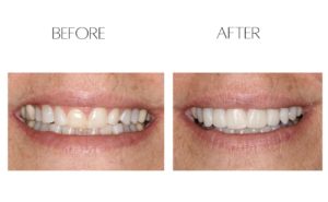 Porcelain Veneers