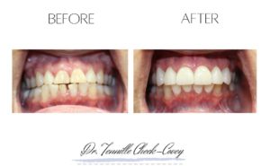 Veneers to remove space, change shape, and change color